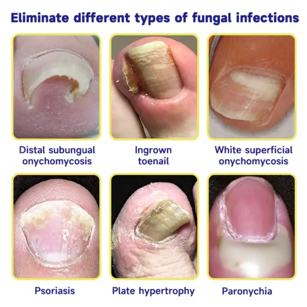 FURZERO™ Multi-Purpose Nail Repair